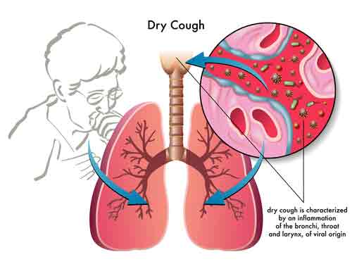 Dust Mite Allergy Symptoms