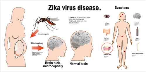 Zika Virus